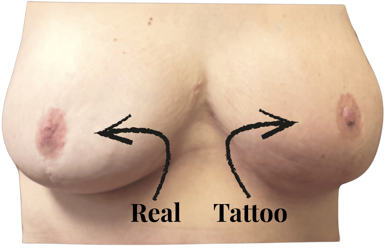 A photo of breasts with a real areola and a tattoo areola